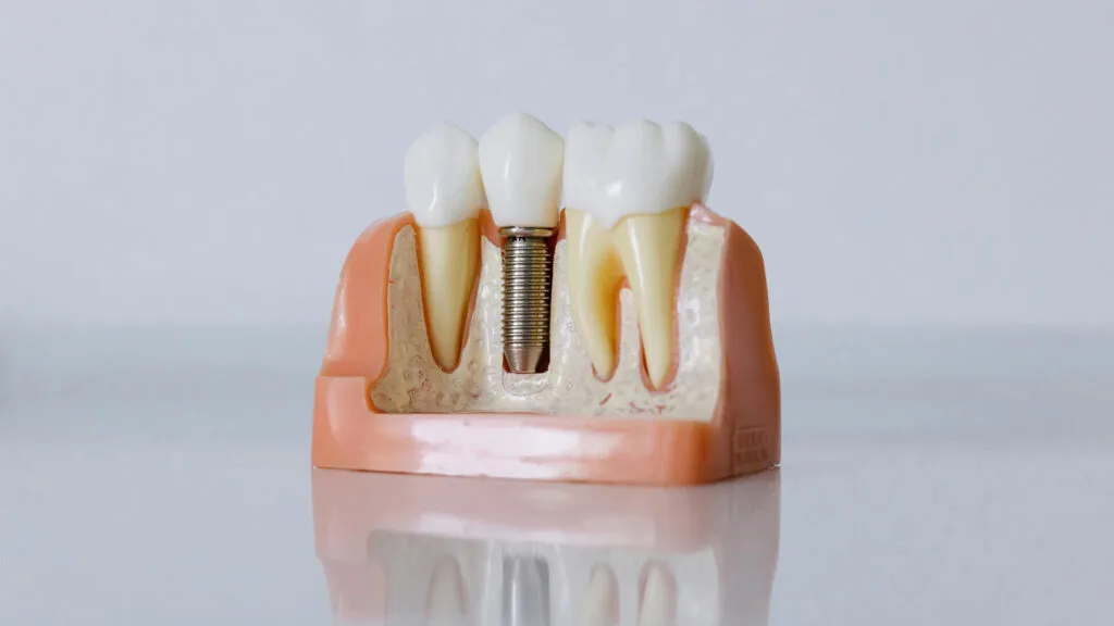 Dental Implants in Al Rayyan - Rayyan Dental Clinic